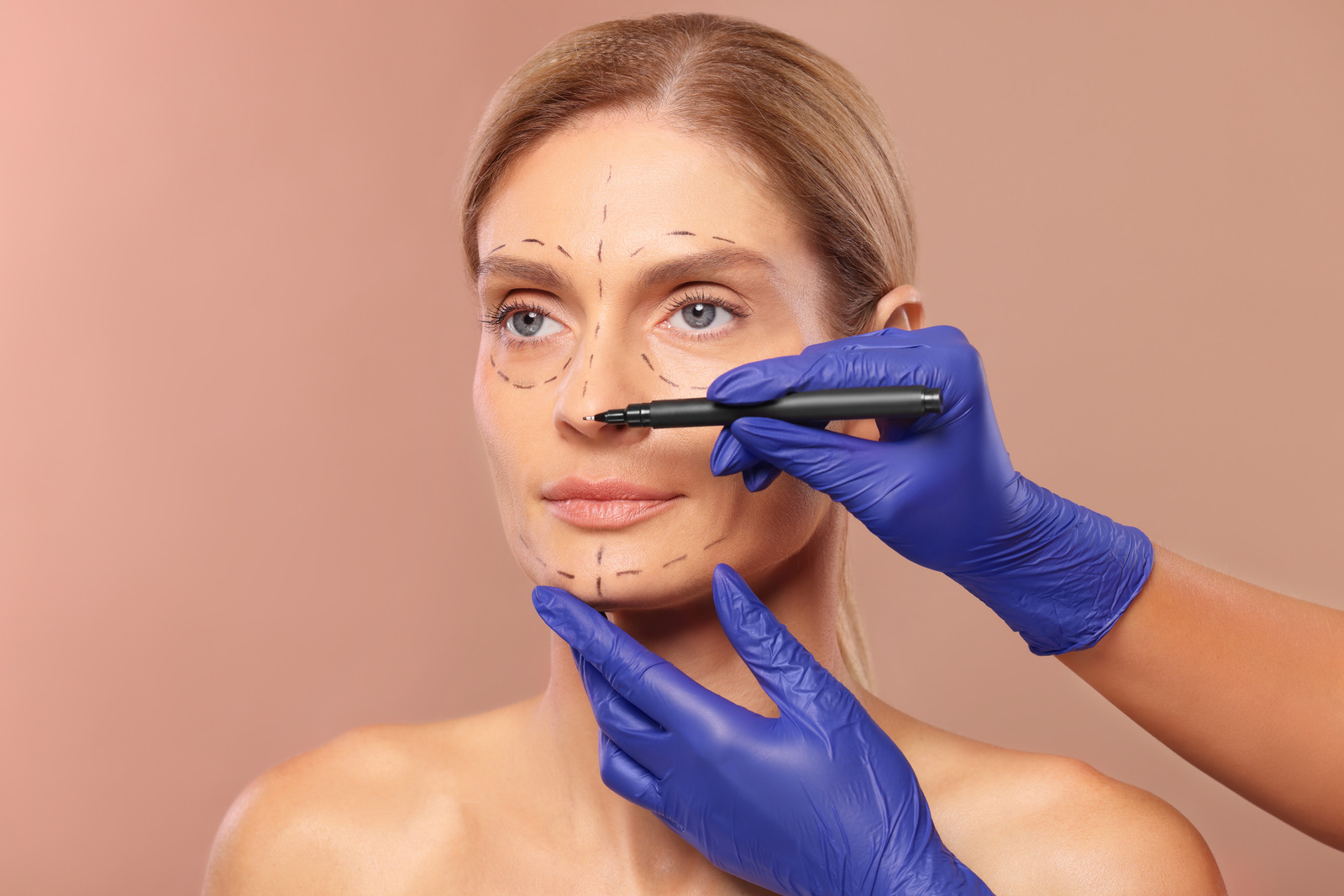 Blefaroplastia